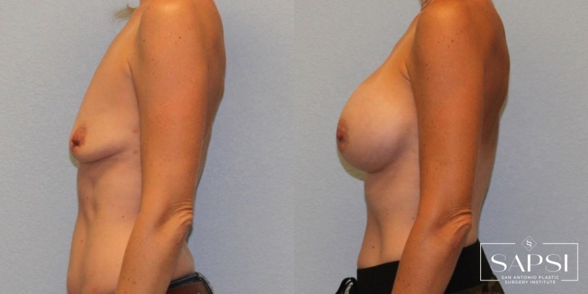 Breast Augmentation: Patient 48 - Before and After 3