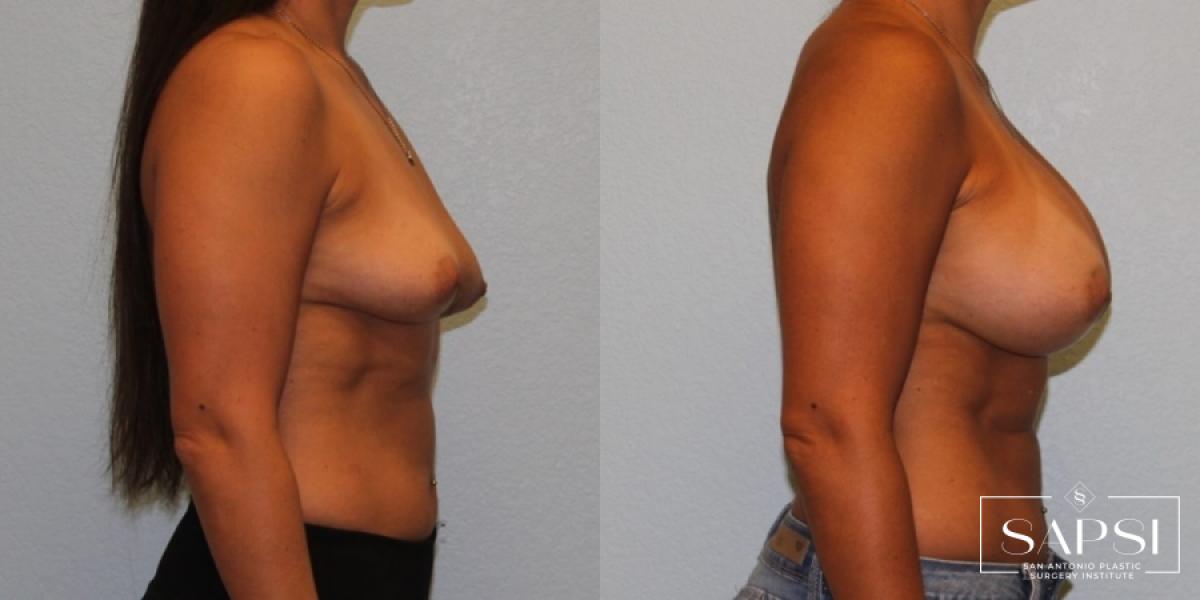 Breast Augmentation: Patient 47 - Before and After 3