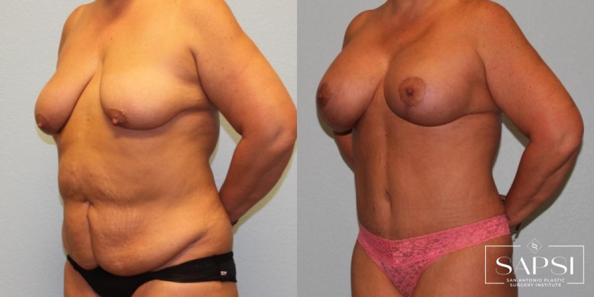 Breast Augmentation With Lift: Patient 12 - Before and After 2