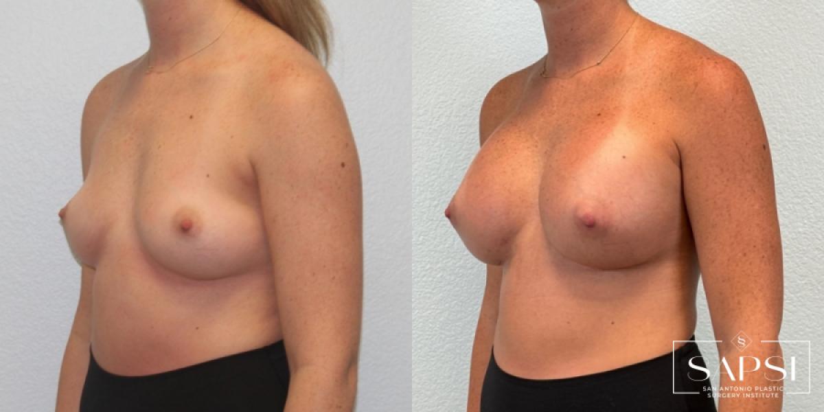 Breast Augmentation: Patient 49 - Before and After 2