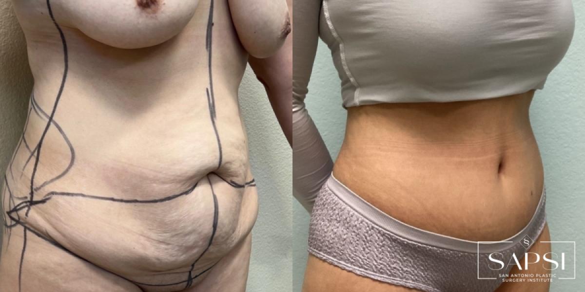 Tummy Tuck: Patient 5 - Before and After 2