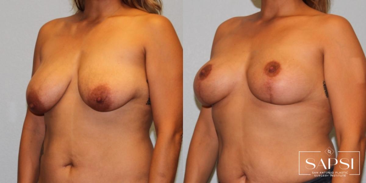 Breast Lift: Patient 14 - Before and After 2