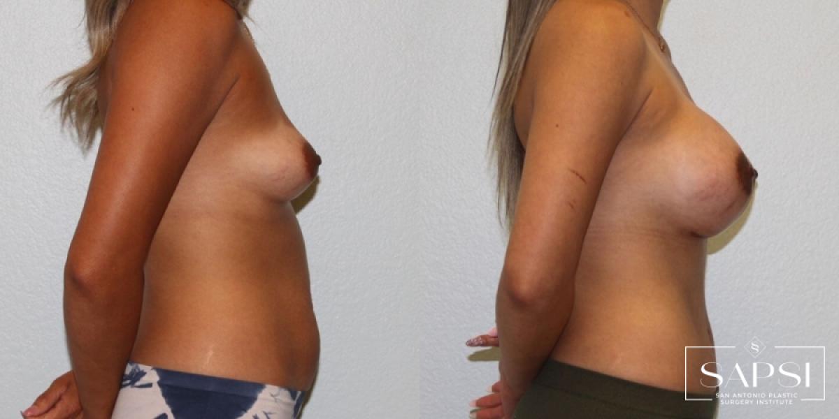 Breast Augmentation: Patient 64 - Before and After 3