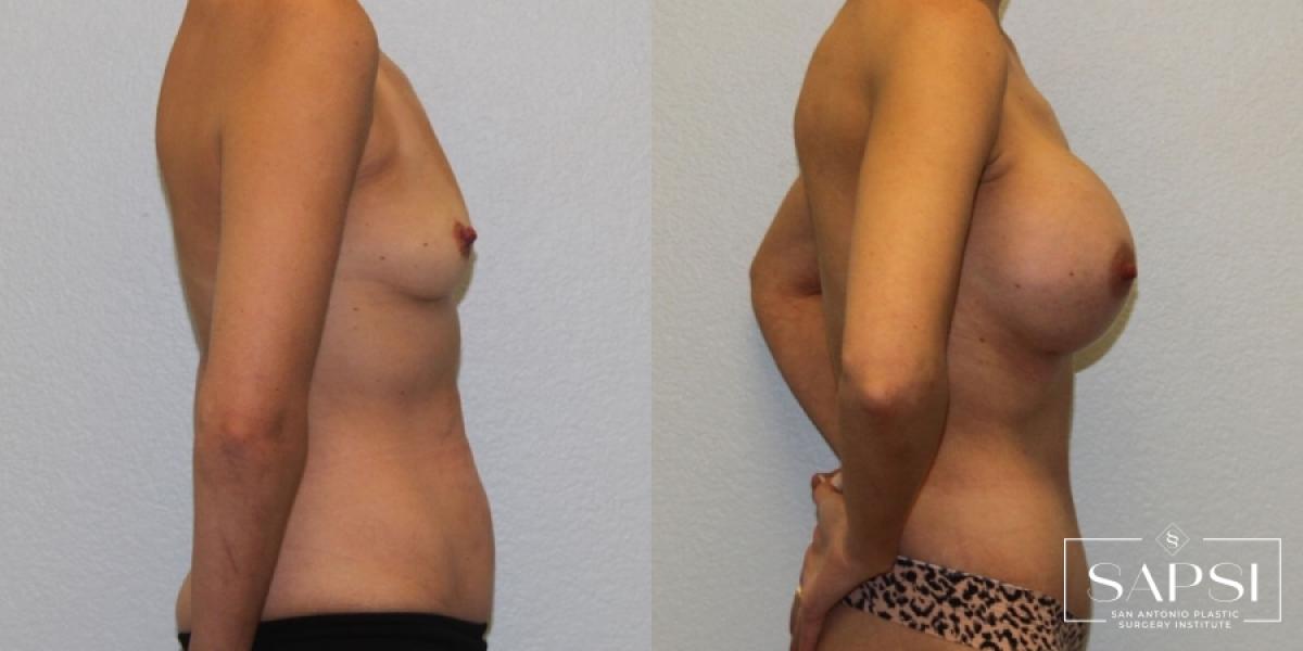 Breast Augmentation: Patient 52 - Before and After 3