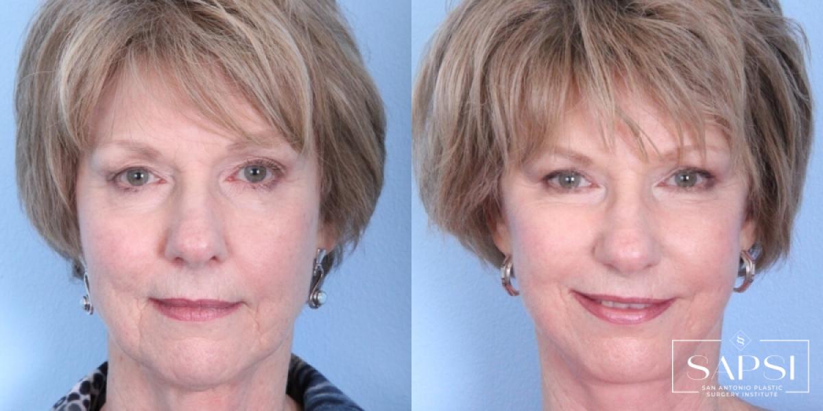 Eyelid Surgery: Patient 2 - Before and After  