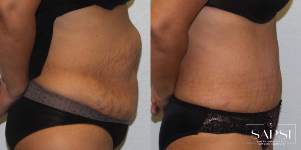 Tummy Tuck: Patient 24 - Before and After 3