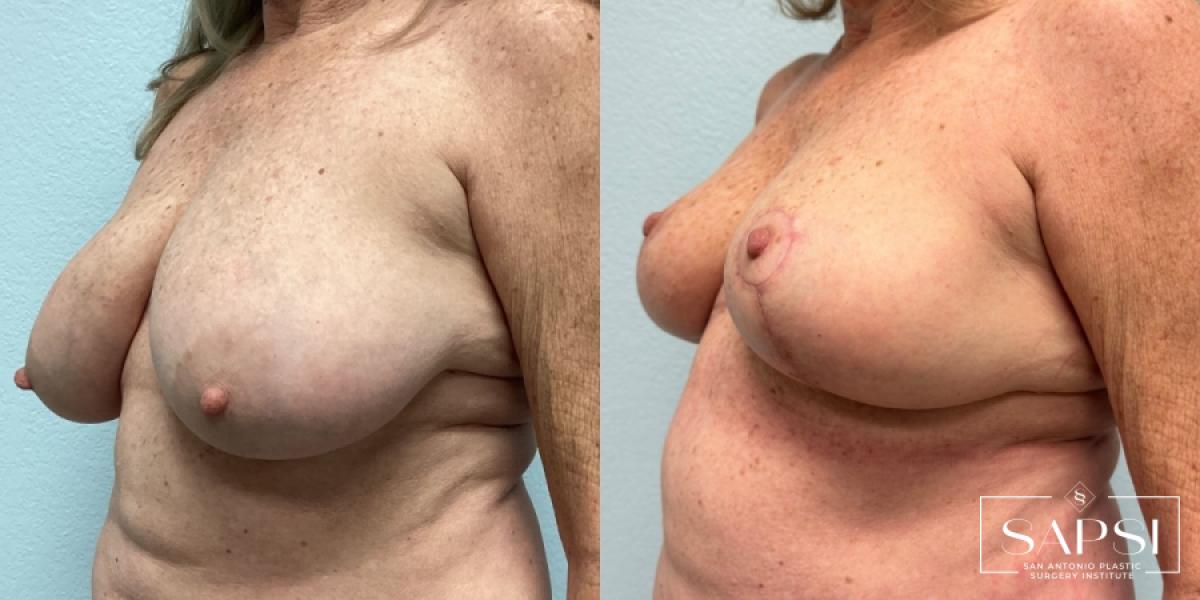 Breast Reduction: Patient 1 - Before and After 2