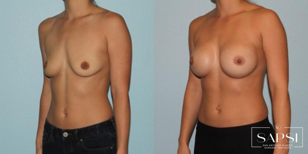 Breast Augmentation: Patient 42 - Before and After 2