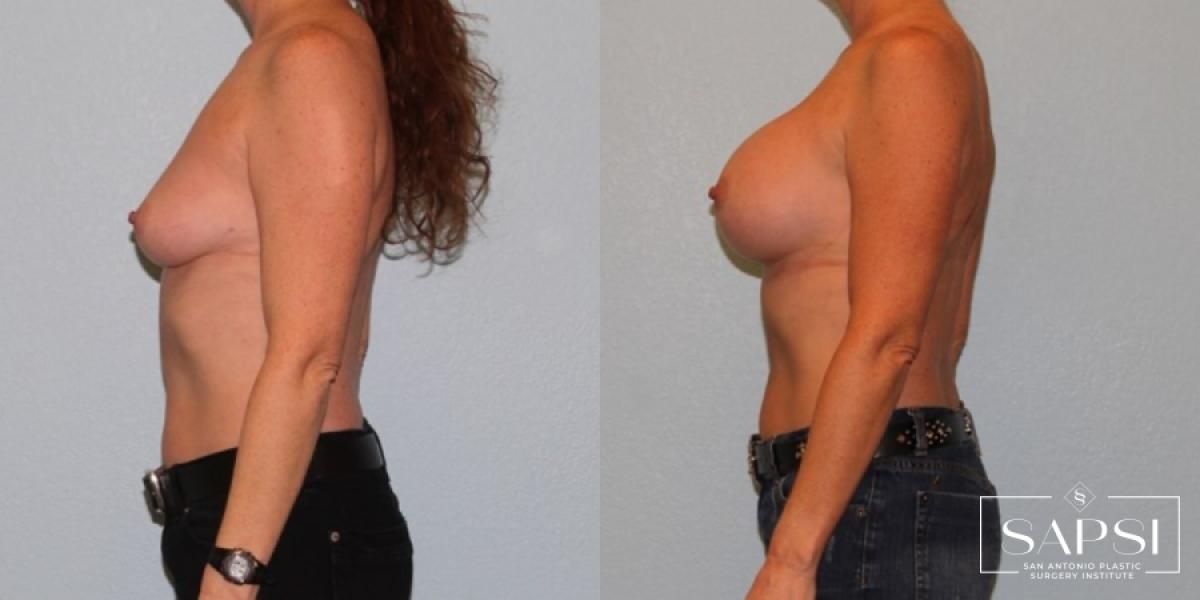 Breast Augmentation: Patient 38 - Before and After 3