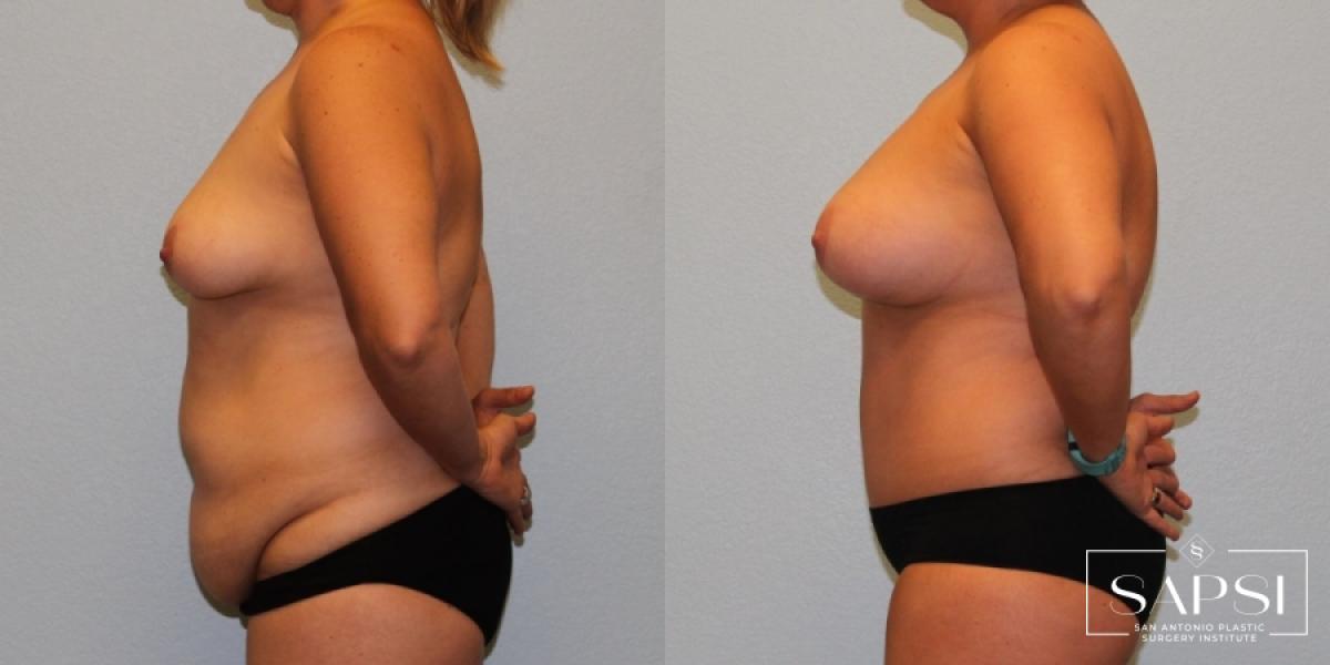 Liposuction: Patient 14 - Before and After 3