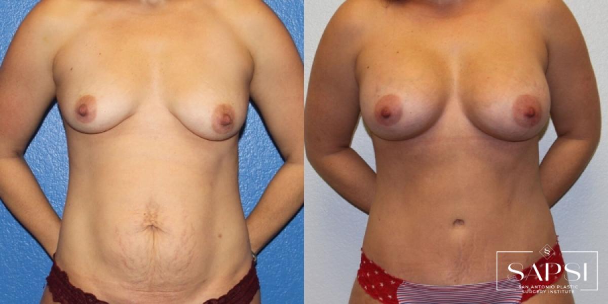 Tummy Tuck: Patient 36 - Before and After 1