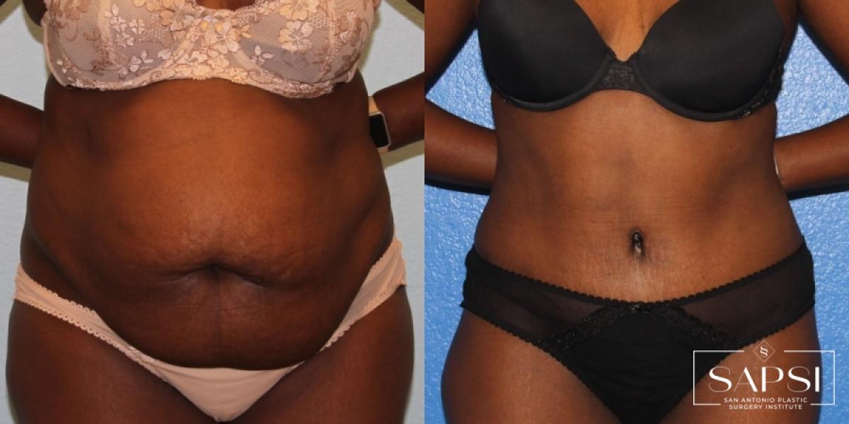 Tummy Tuck: Patient 18 - Before and After 1