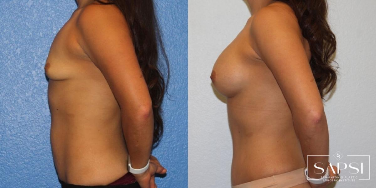 Tummy Tuck: Patient 33 - Before and After 3