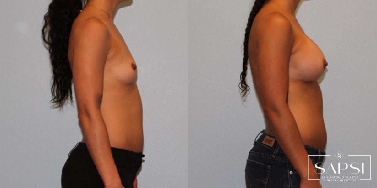 Breast Augmentation: Patient 46 - Before and After 3