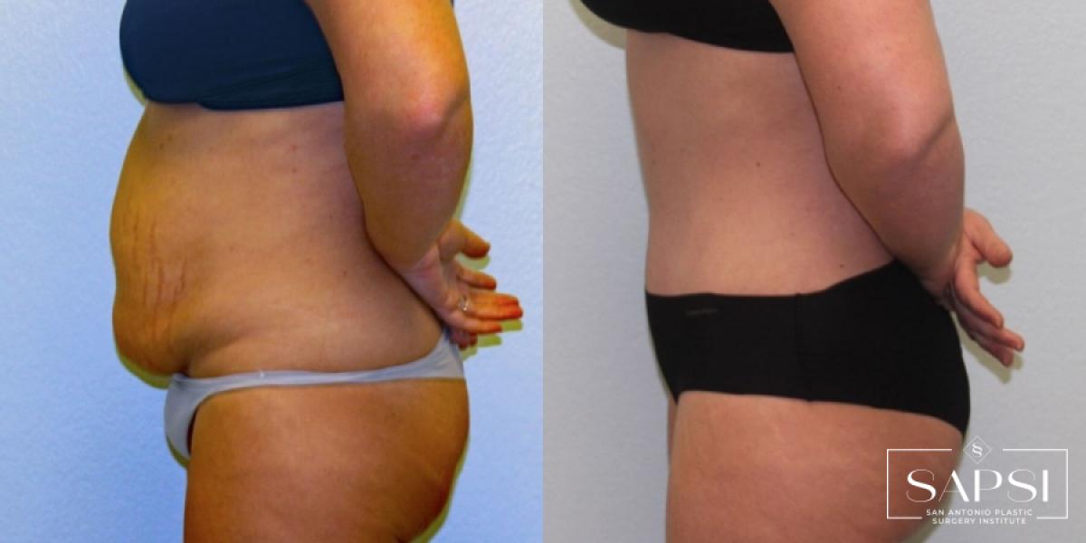 Tummy Tuck: Patient 9 - Before and After 3