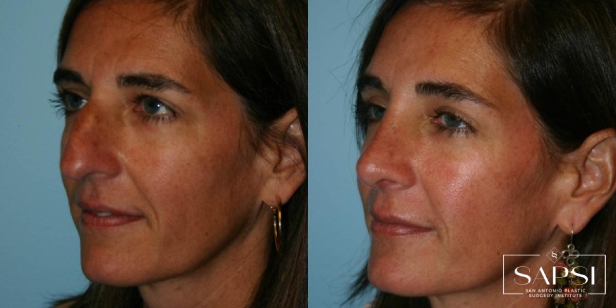 Rhinoplasty: Patient 1 - Before and After 2