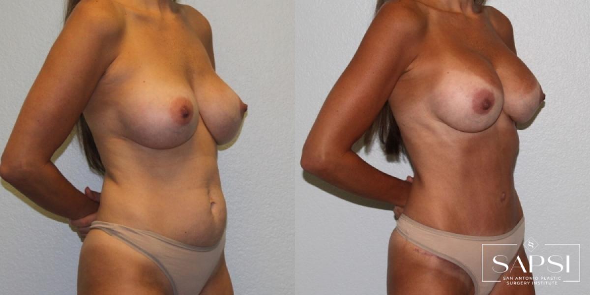 Breast Revision: Patient 5 - Before and After 2