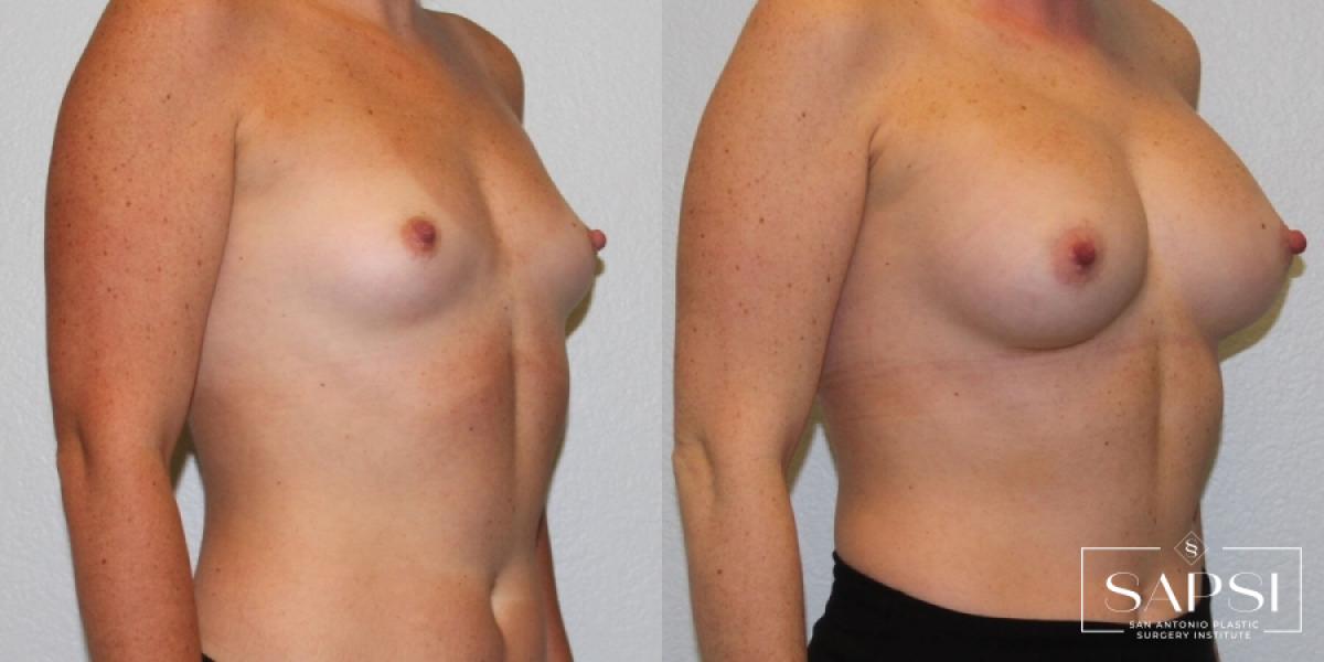 Breast Augmentation: Patient 30 - Before and After 2