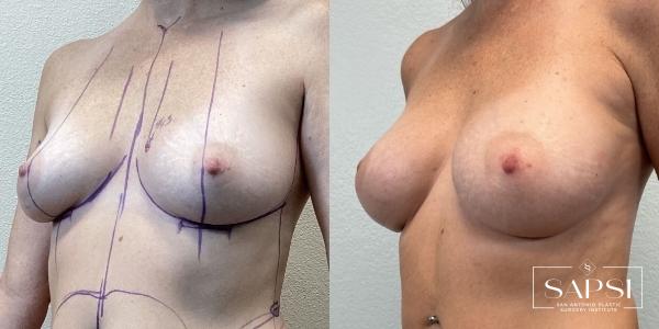 Breast Augmentation: Patient 52 - Before and After 