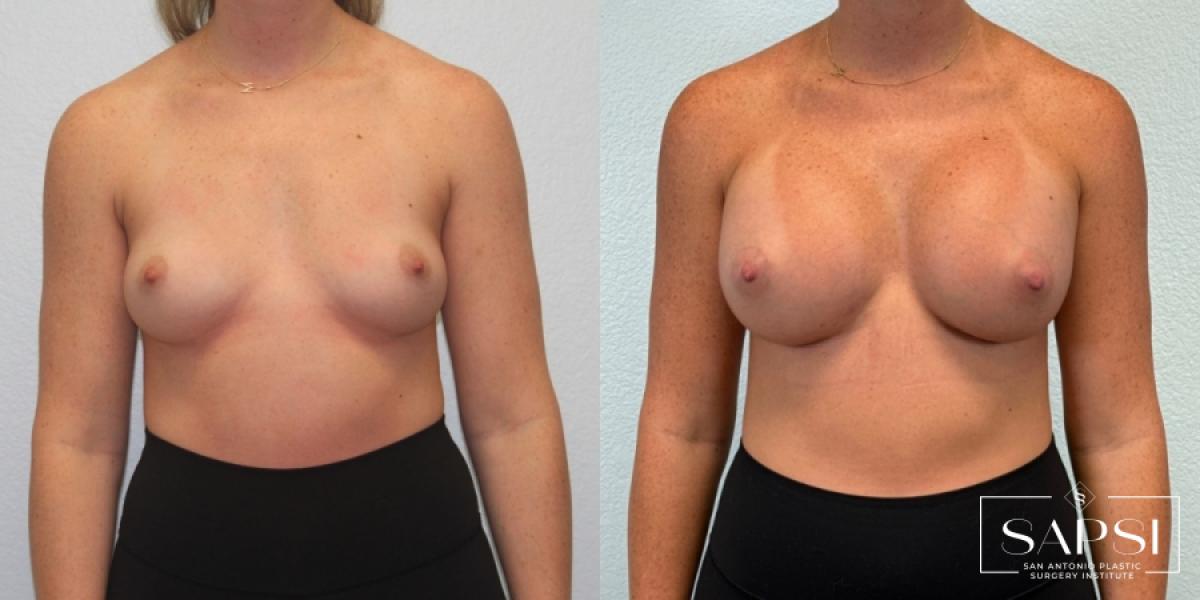 Breast Augmentation: Patient 50 - Before and After 