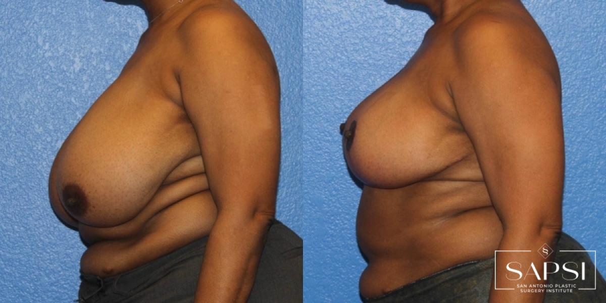 Breast Reduction: Patient 2 - Before and After 3