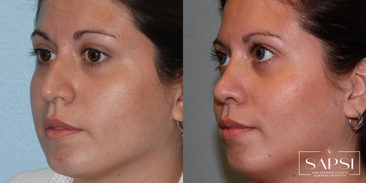 Facelift: Patient 7 - Before and After 2