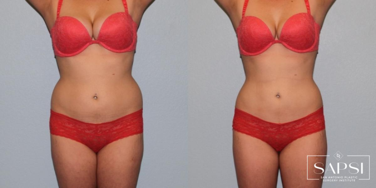 Body Contouring: Patient 1 - Before and After  