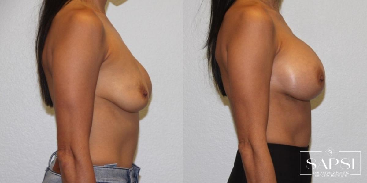 Breast Revision: Patient 8 - Before and After 3