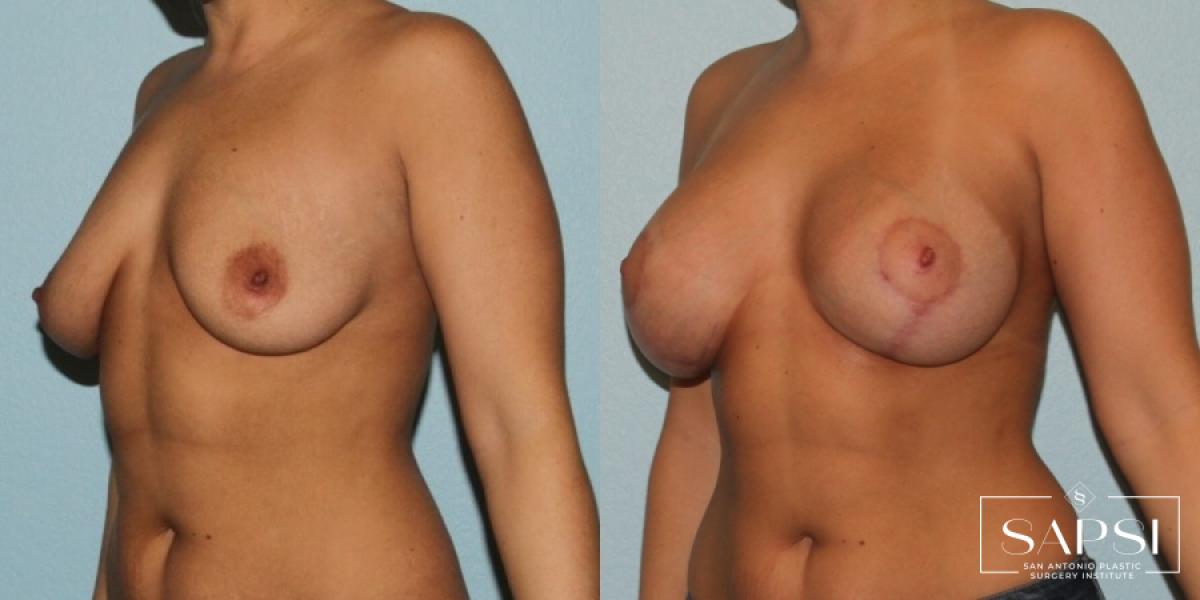 Breast Lift: Patient 16 - Before and After 2