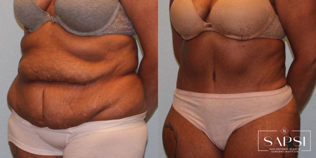 Tummy Tuck: Patient 26 - Before and After 2