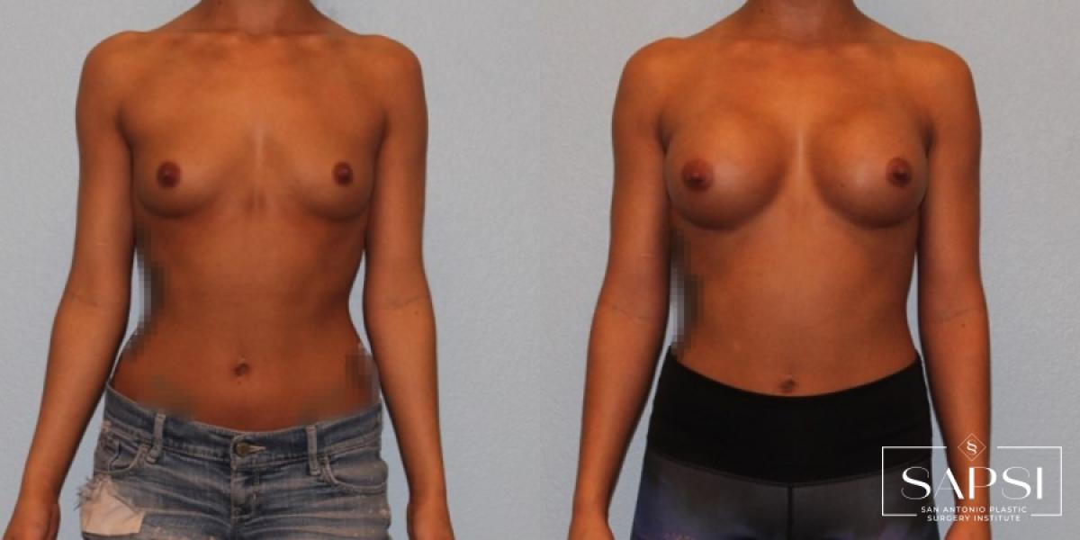 Breast Augmentation: Patient 38 - Before and After 