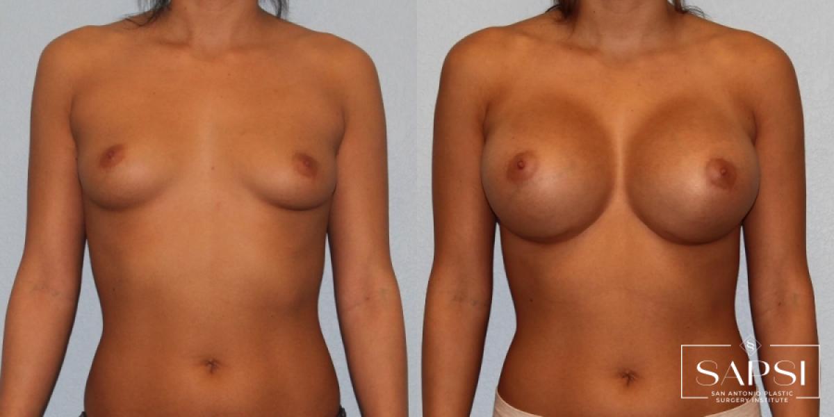 Breast Augmentation: Patient 17 - Before and After 