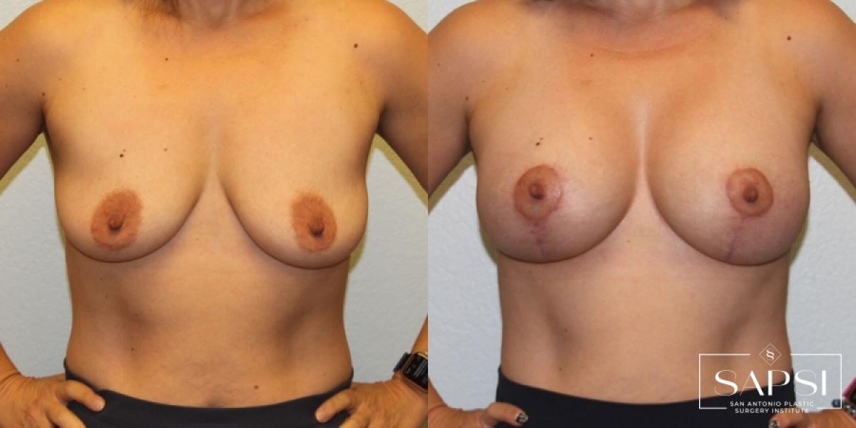 Breast Augmentation With Lift: Patient 4 - Before and After  