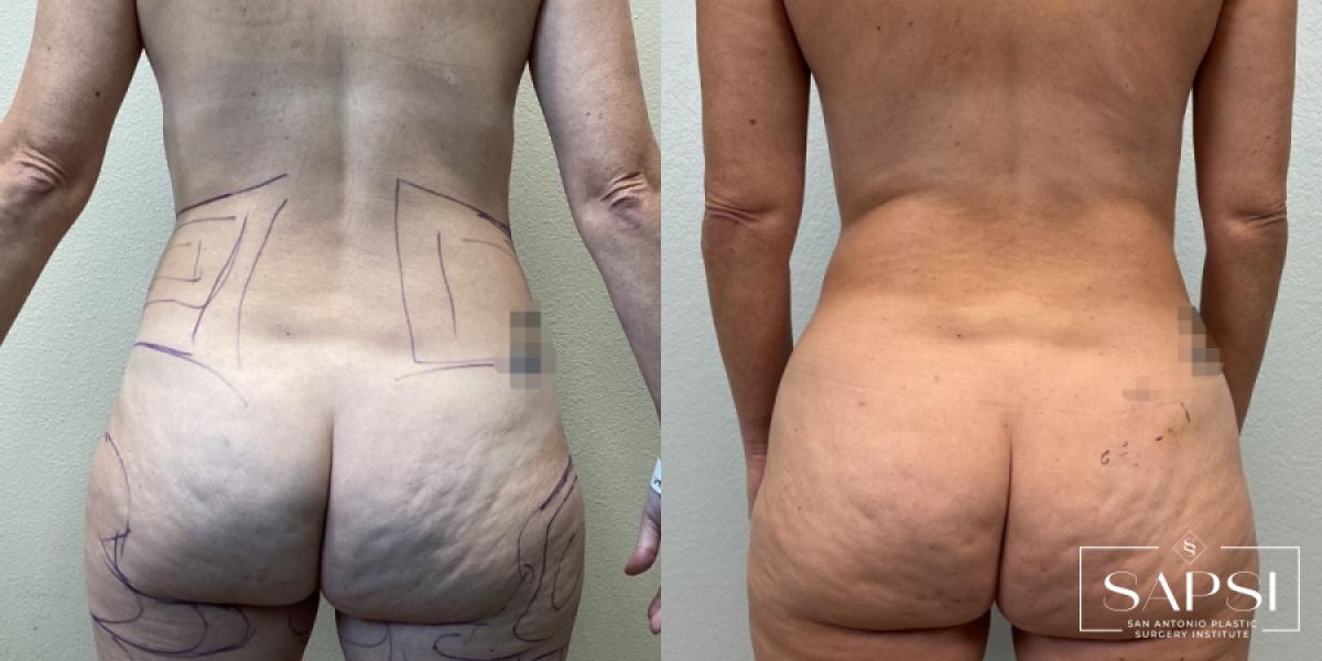 Liposuction: Patient 2 - Before and After 3