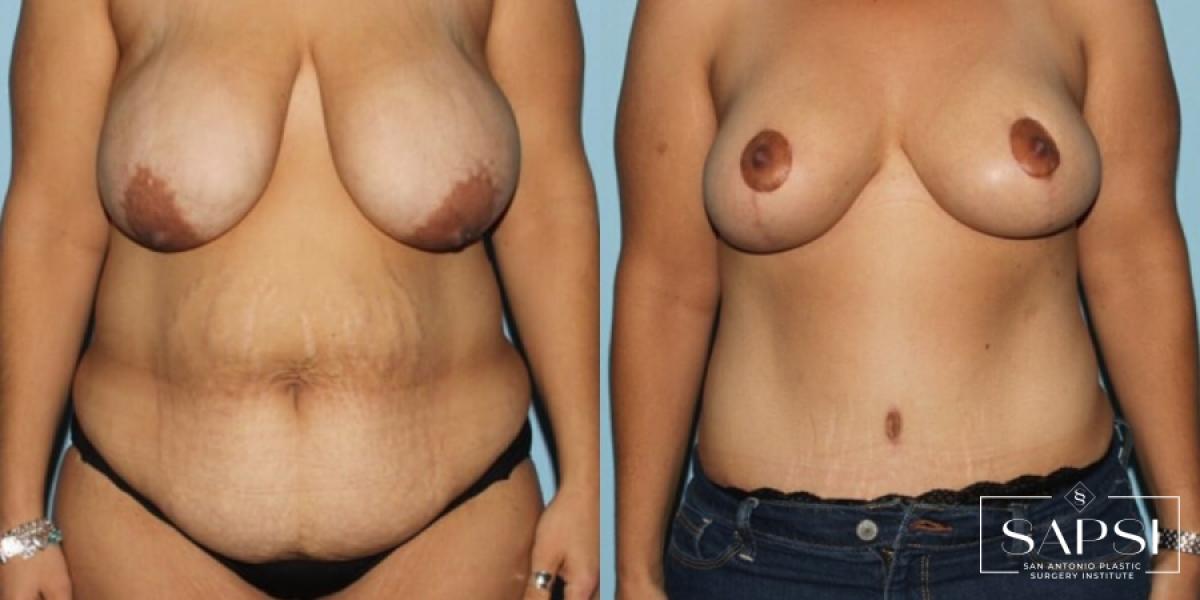 Tummy Tuck: Patient 44 - Before and After 1