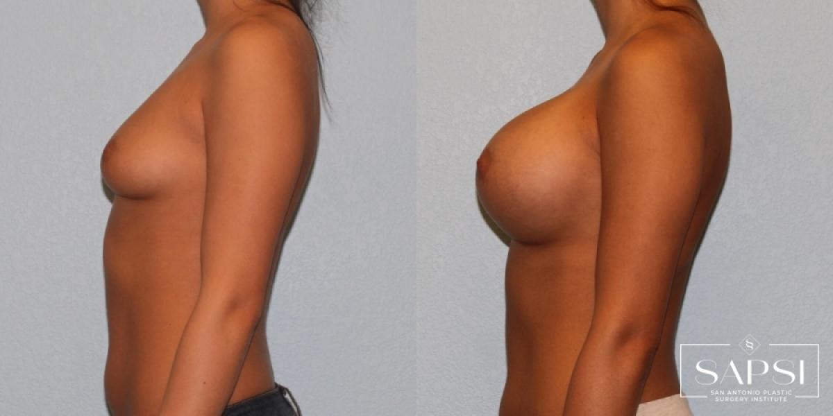 Breast Augmentation: Patient 16 - Before and After 3