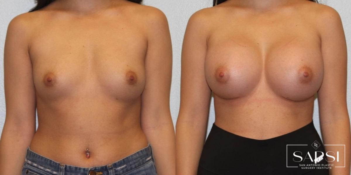 Breast Augmentation: Patient 27 - Before and After 