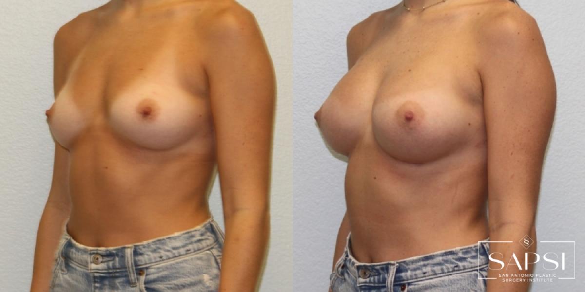 Breast Augmentation: Patient 61 - Before and After 2