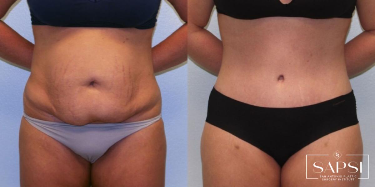 Tummy Tuck: Patient 9 - Before and After  