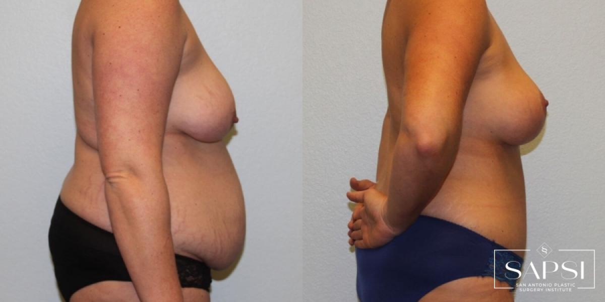 Body Lift: Patient 1 - Before and After 3