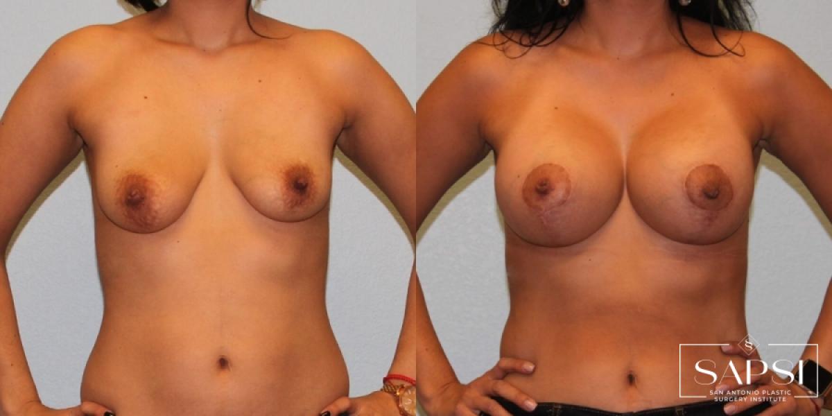 Breast Augmentation With Lift: Patient 10 - Before and After  