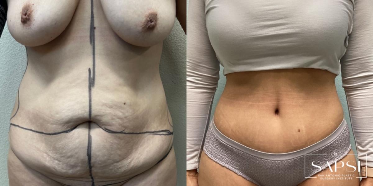 Tummy Tuck: Patient 5 - Before and After  