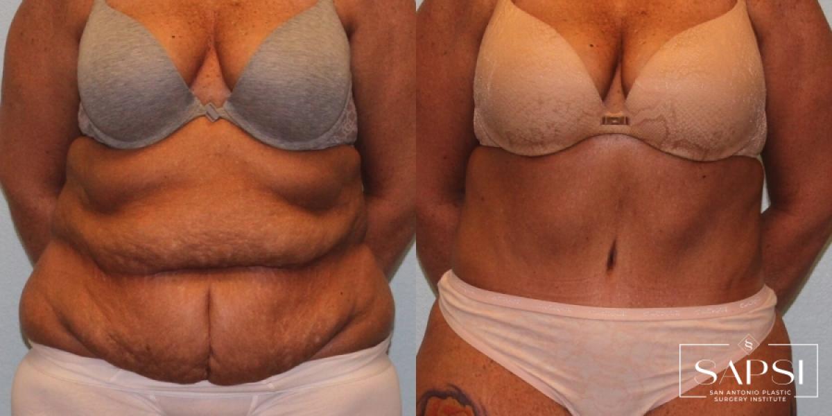 Tummy Tuck: Patient 26 - Before and After 1