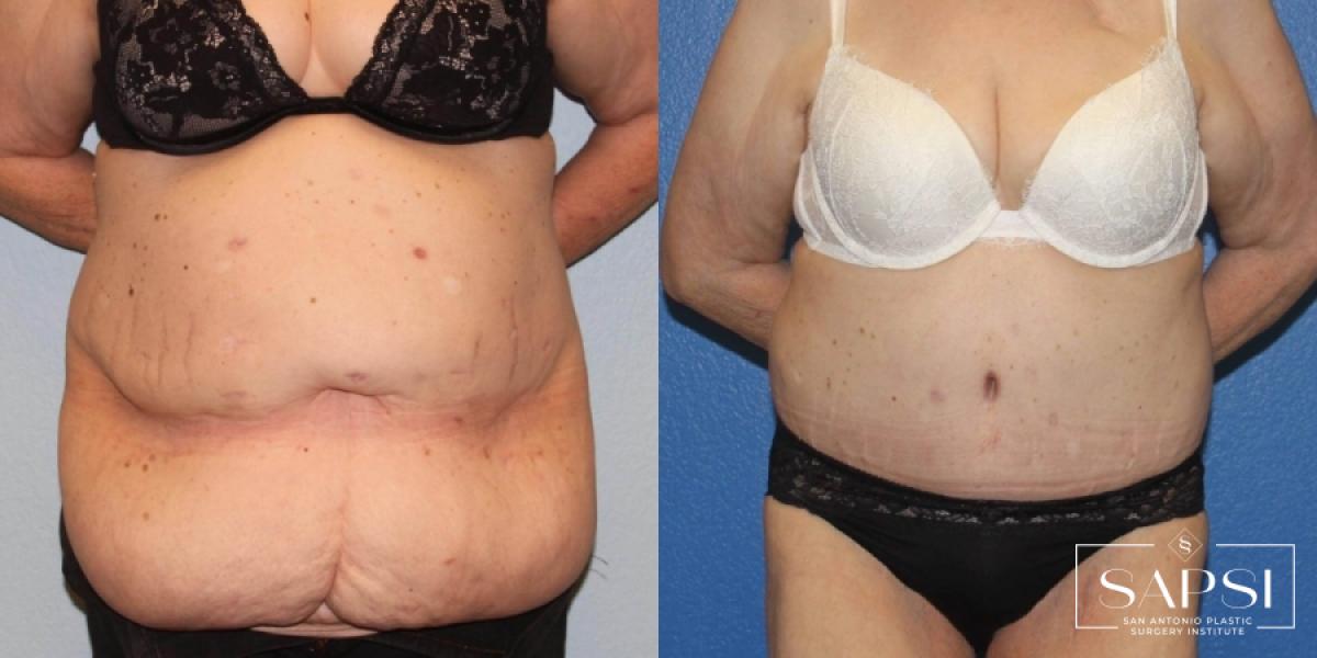 Tummy Tuck: Patient 48 - Before and After 1