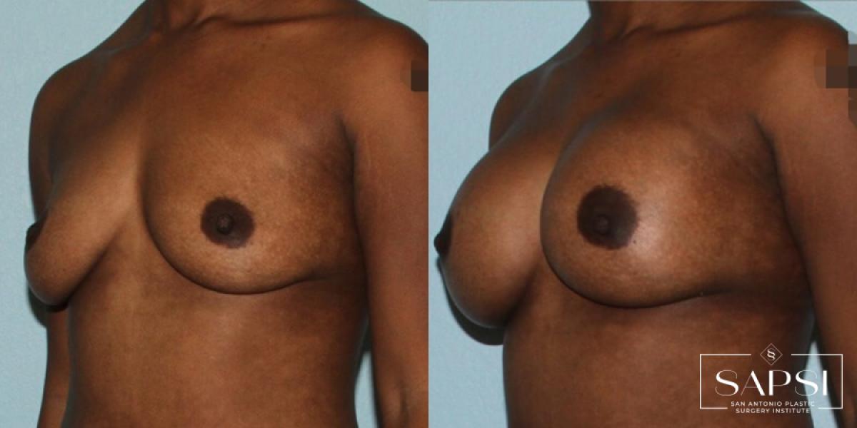 Breast Augmentation: Patient 45 - Before and After 2