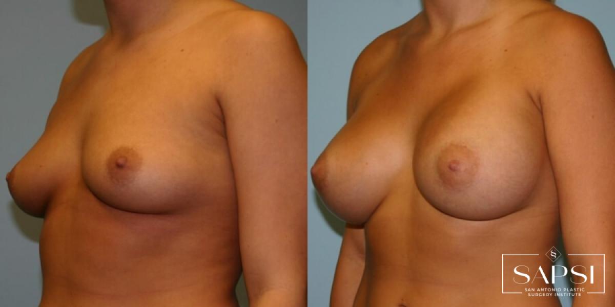 Breast Augmentation: Patient 7 - Before and After 2