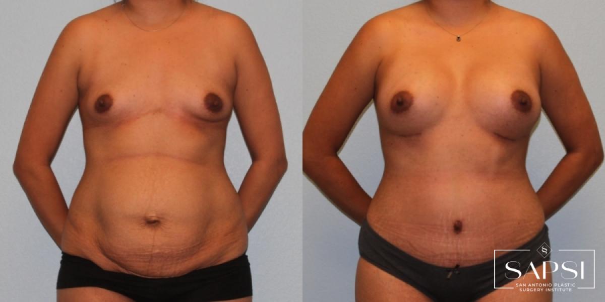 Tummy Tuck: Patient 47 - Before and After 1