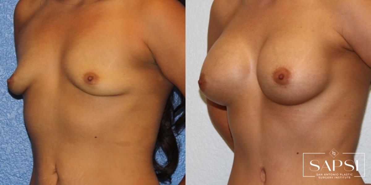 Breast Augmentation: Patient 79 - Before and After 2