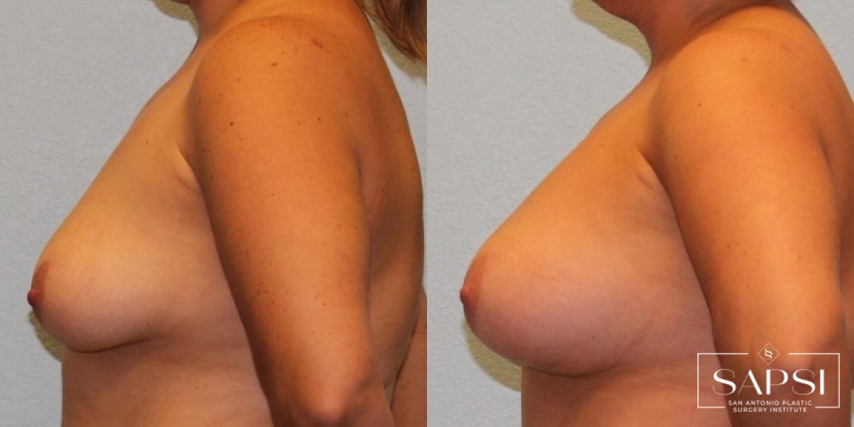 Breast Augmentation: Patient 76 - Before and After 3