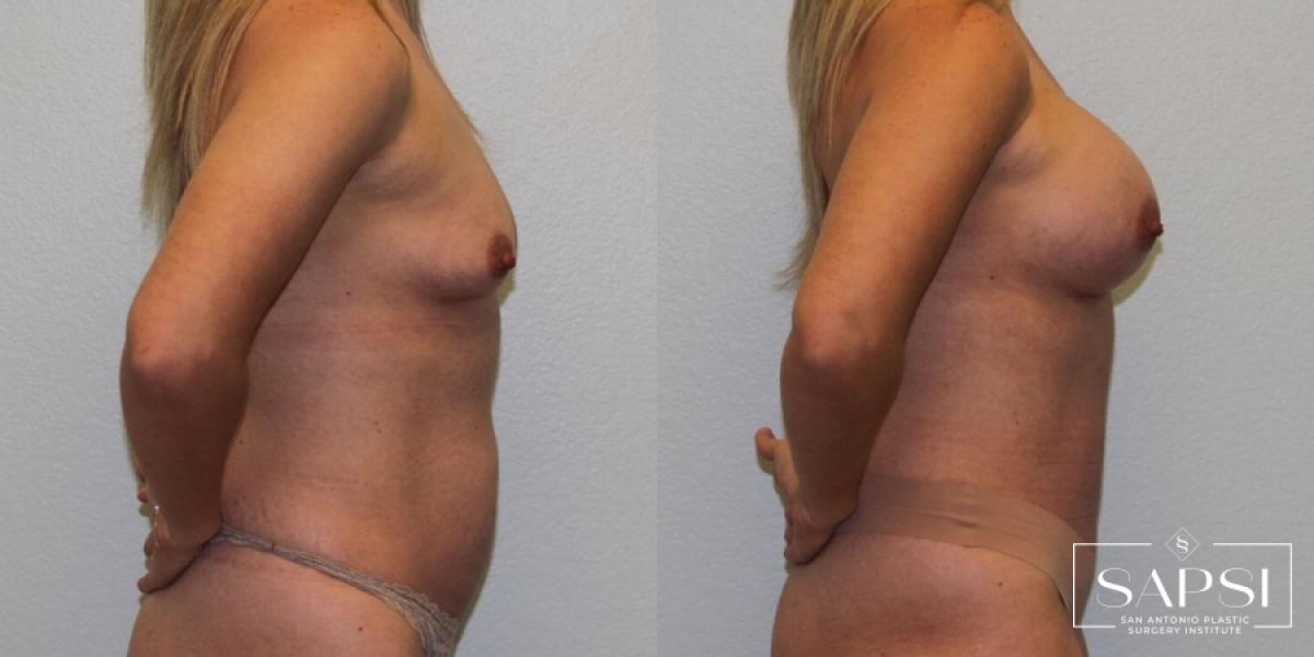 Breast Augmentation: Patient 57 - Before and After 3